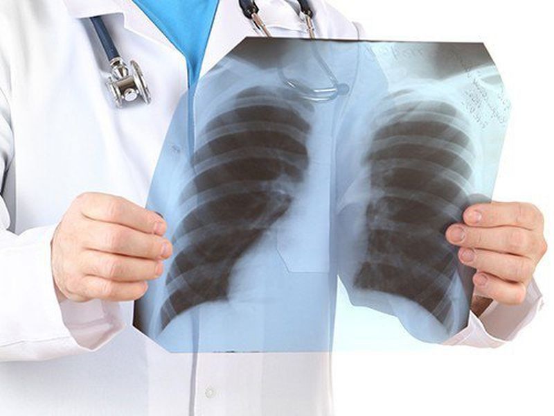 В Минздраве Карелии рассказали, как избежать рака легких