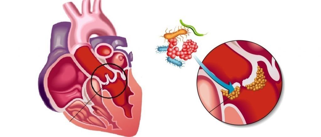 У 21-летней петрозаводчанки с жалобами на температуру выявили опасное заболевание сердца