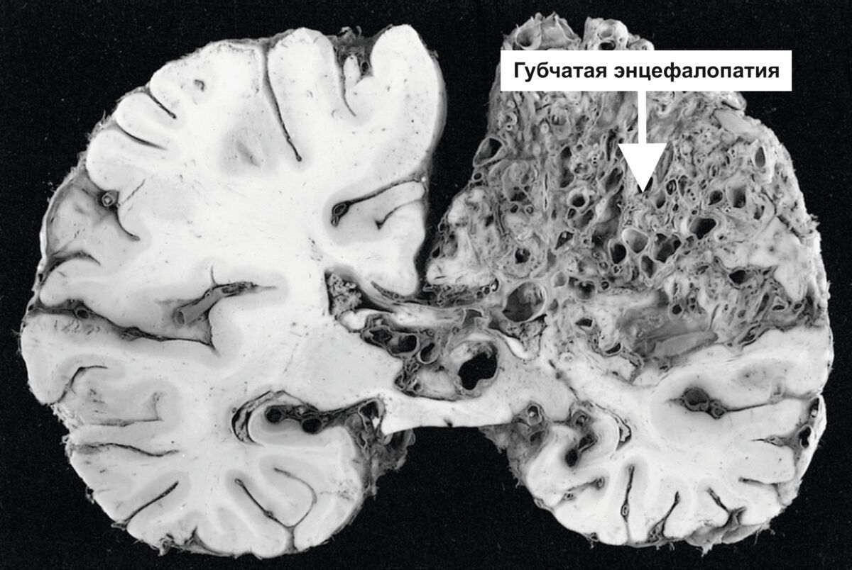 Человечеству грозят прионные заболевания, предупредили в Минздраве
