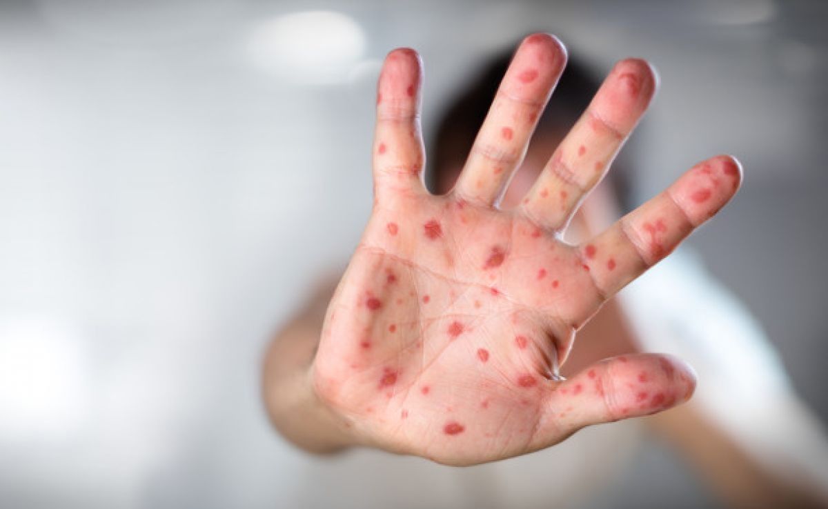 Вспышки кори выявили уже в 44 регионах России