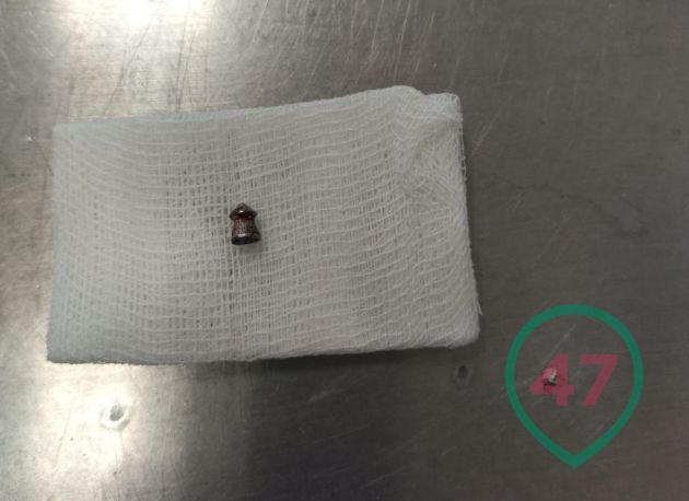 После прогулки в парке в Ленобласти жительнице Карелии пришлось удалять пулю