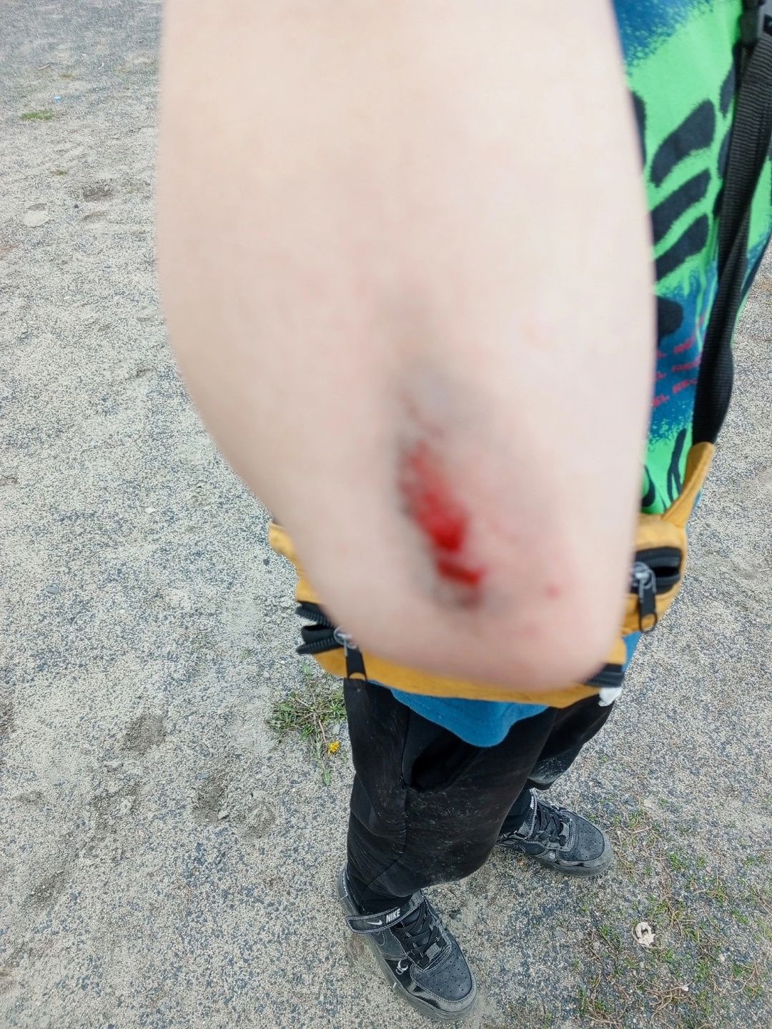 Щебенка, камень и стекло: школьный стадион травмирует детей в Кондопоге