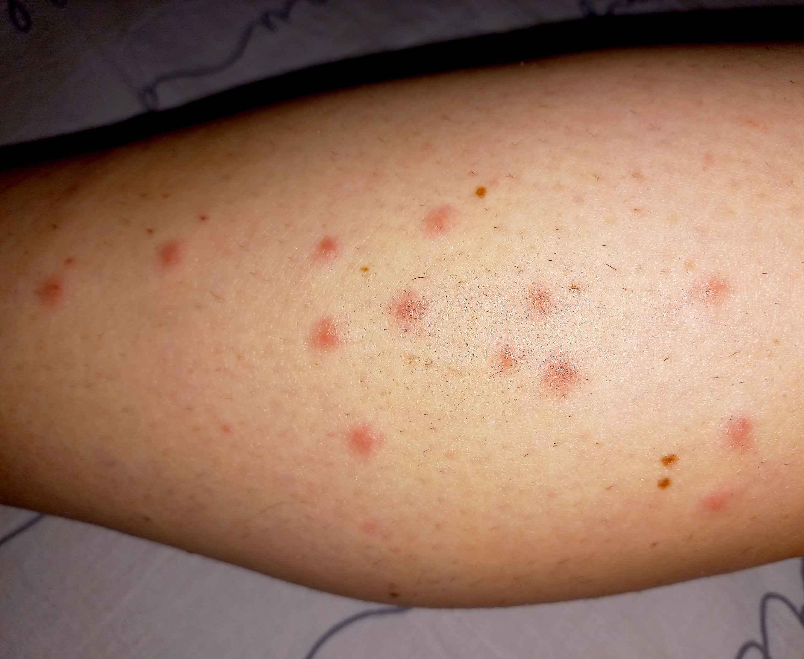 Людей обсыпало после купания в зараженном озере Карелии