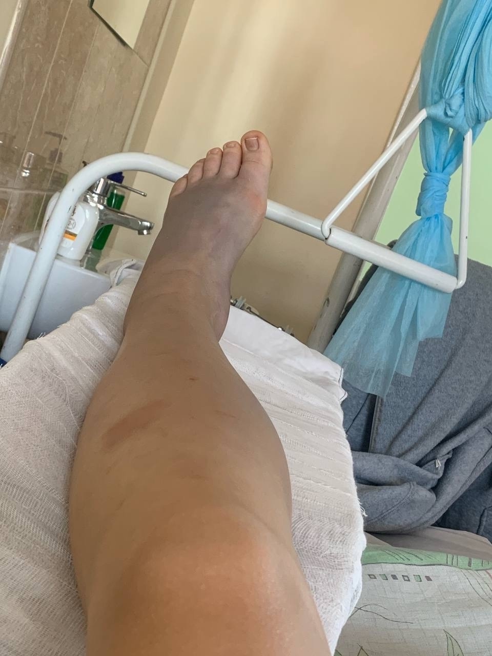 Девушка пострадала от ядовитой змеи в Карелии