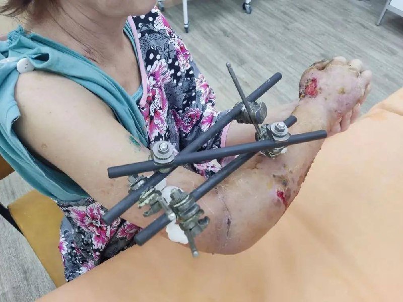 Карельские врачи успешно пришили руку женщине, которая потеряла ее на производстве