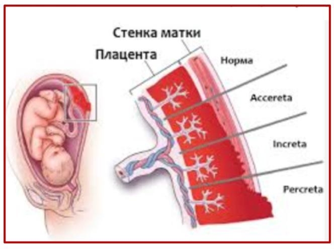 Три женщины с врастанием плаценты успешно прооперированы в Республиканском перинатальном центре в этом году