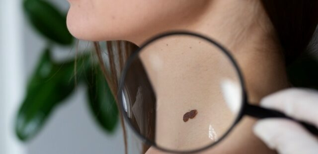 Карельский онколог рассказала, в чем опасность «домашнего» удаления новообразований