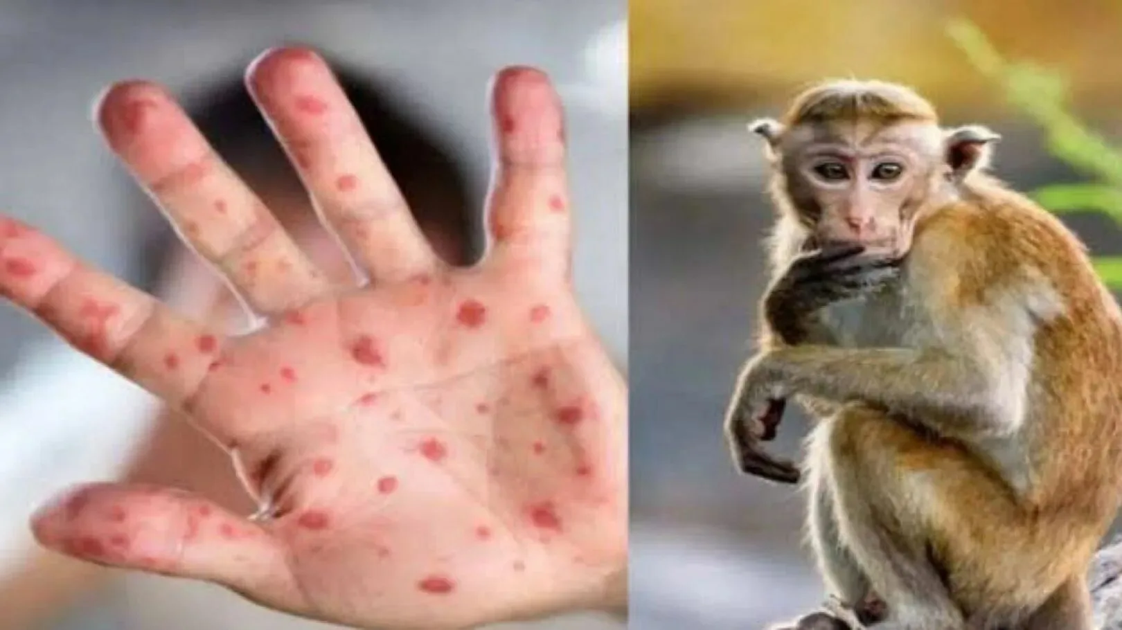 Новый случай заражения оспой обезьян зафиксирован в Петербурге