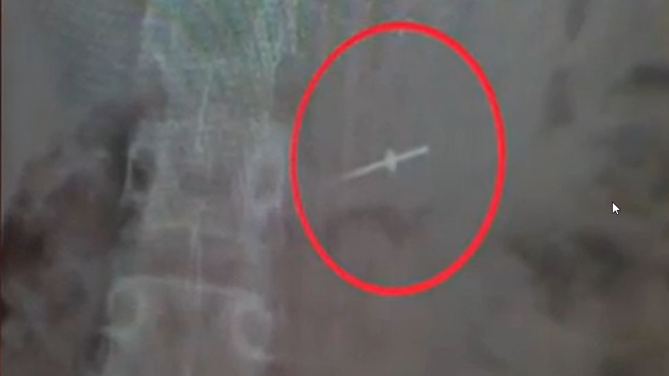 История с иглой в желудке девятилетней девочки после посещения стоматолога в Петрозаводске обернулась уголовным делом