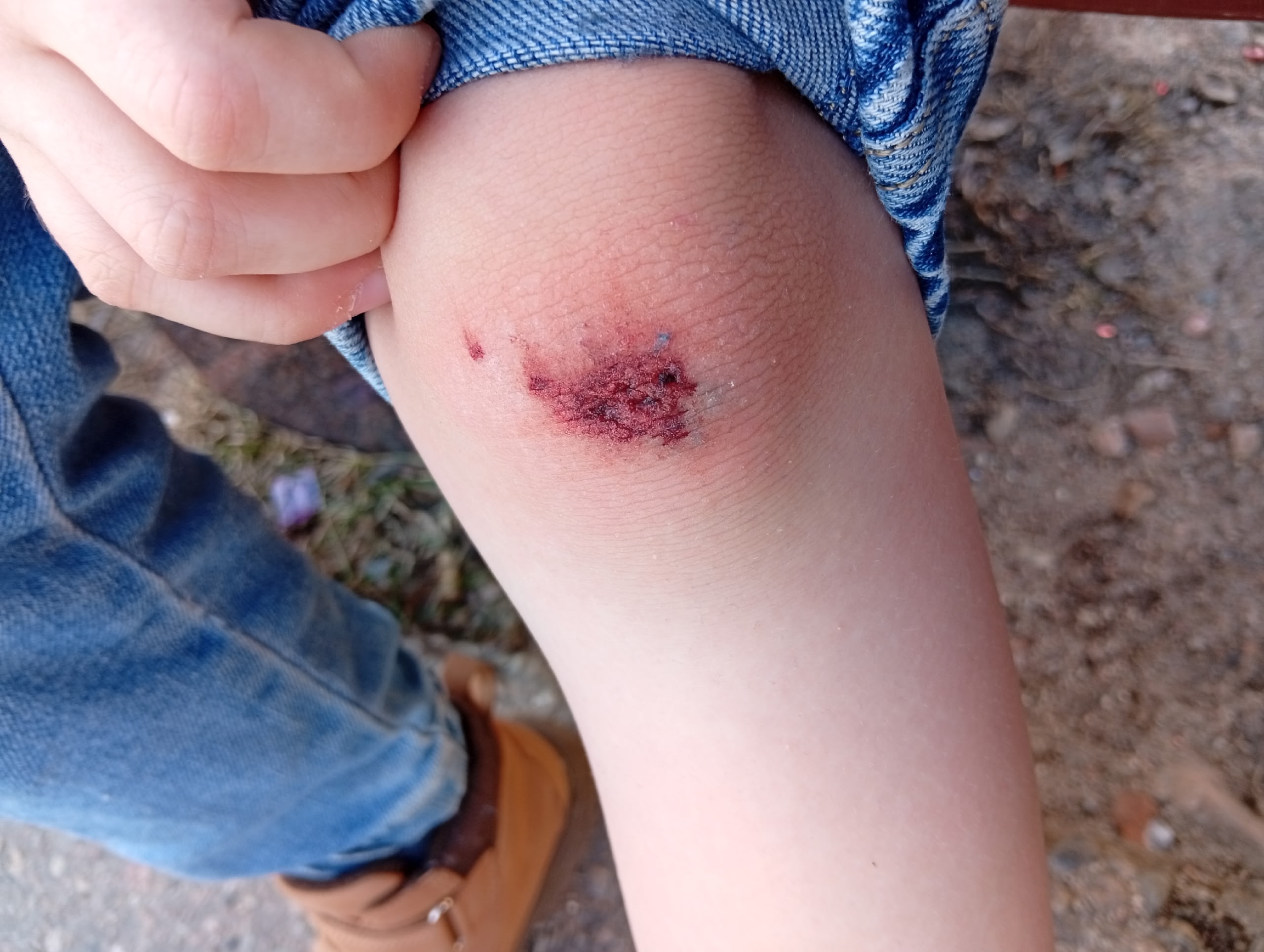 Кучи песка на площади в Костомукше привели к травме ребенка