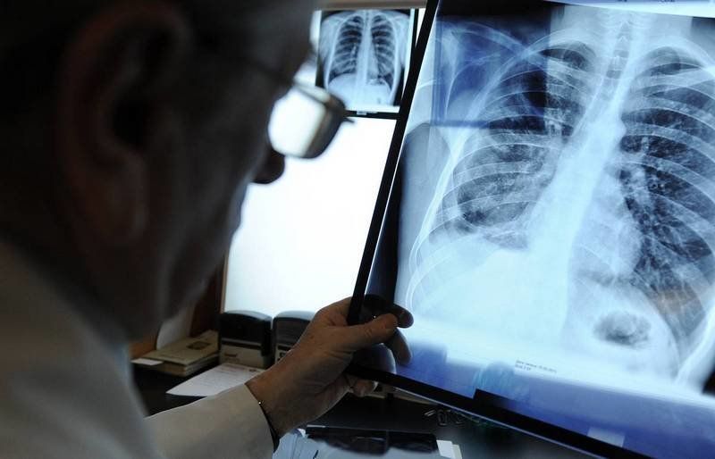 В Костомукше мужчина неделю ходил на работу с ковидной пневмонией